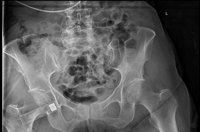 Fragility fractures, including complete non-displaced Denis type 1 right sacral fracture and bilateral superior and inferior pubic ramus fractures in a 70-year-old woman